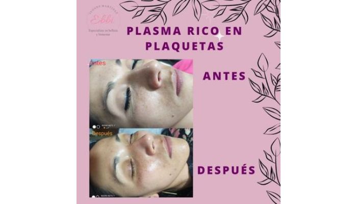 Tratamiento Antienvejecimiento con Plasma Rico en Factores de Crecimiento