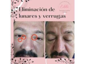 Remoción y eliminación de verrugas y lunares
